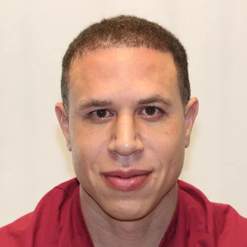 Mike Bibby before hair transplant