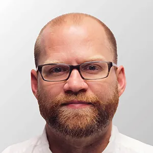 Nick G. before hair transplant