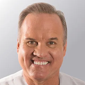 Ryan Sandberg After Hair Transplant Results