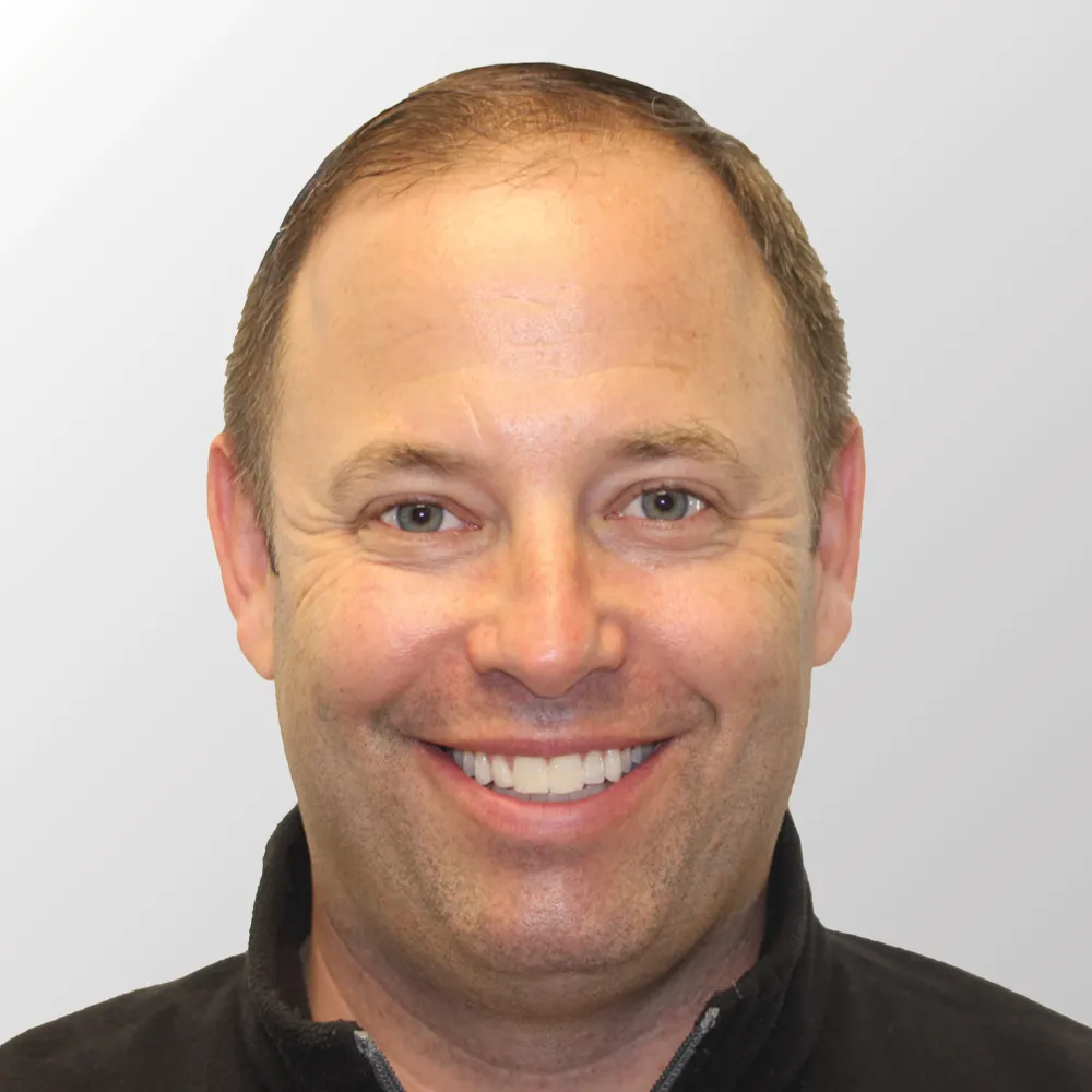 Todd D. before hair transplant
