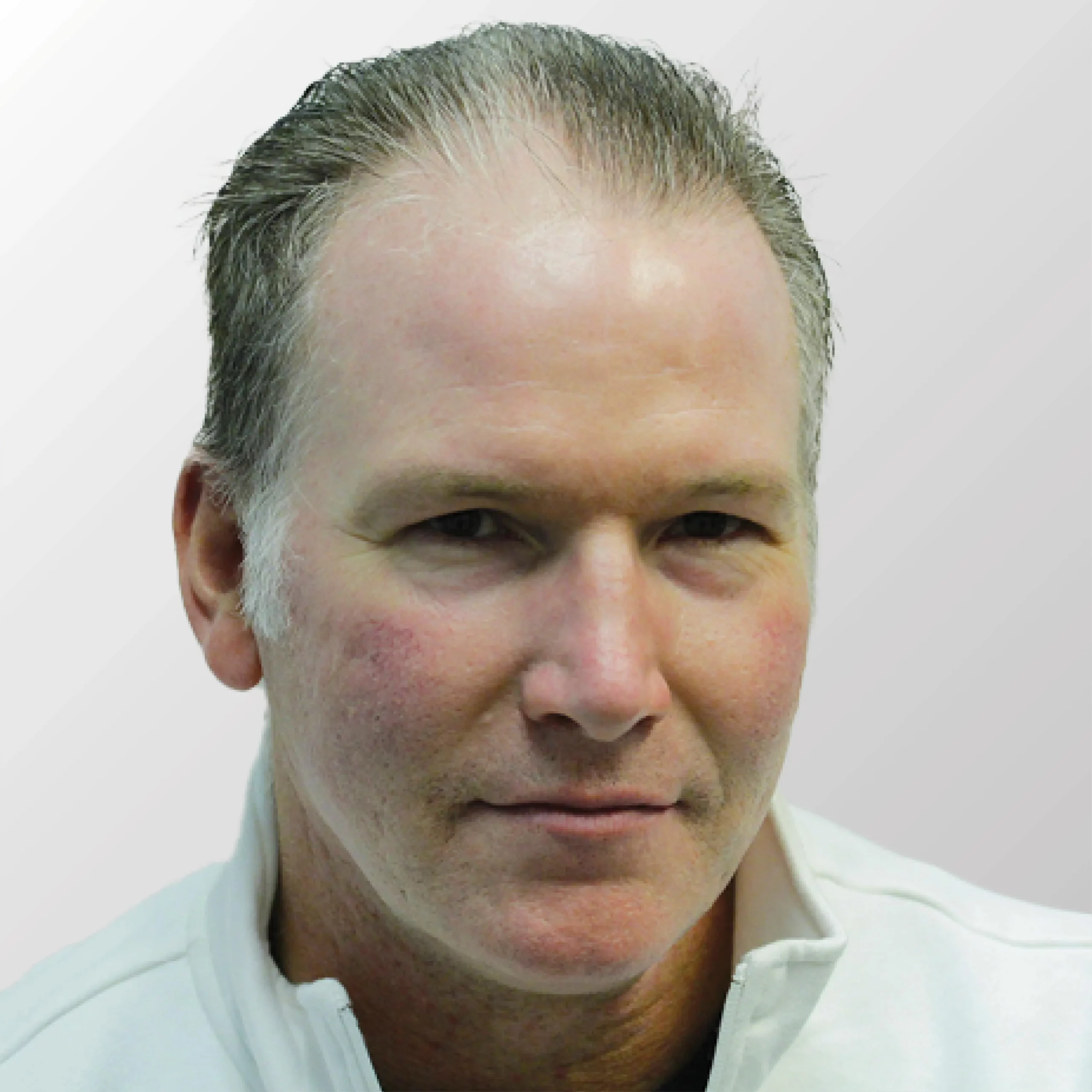 Jim Cornelison before hair transplant