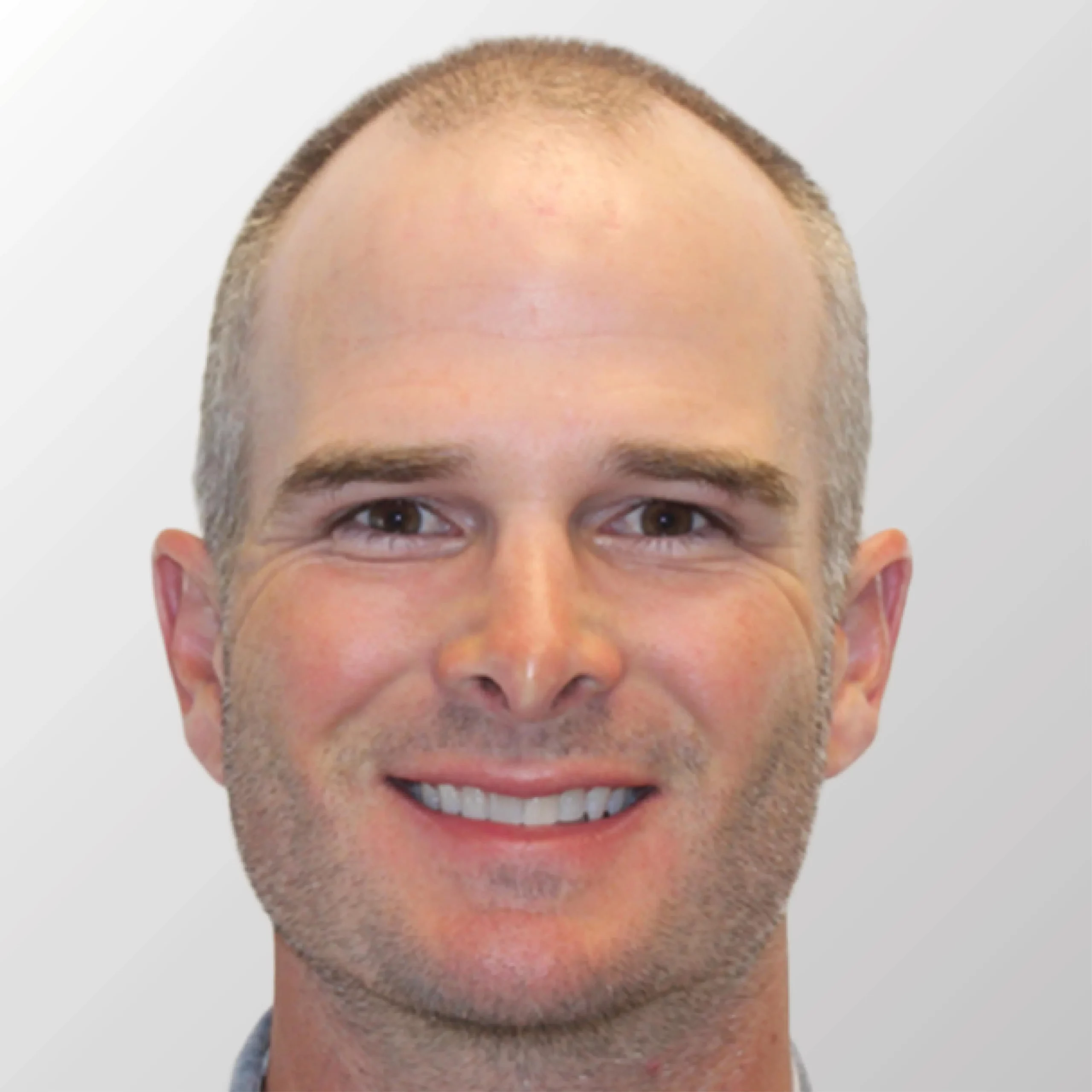 Kevin Streelman's Before Hair Transplant