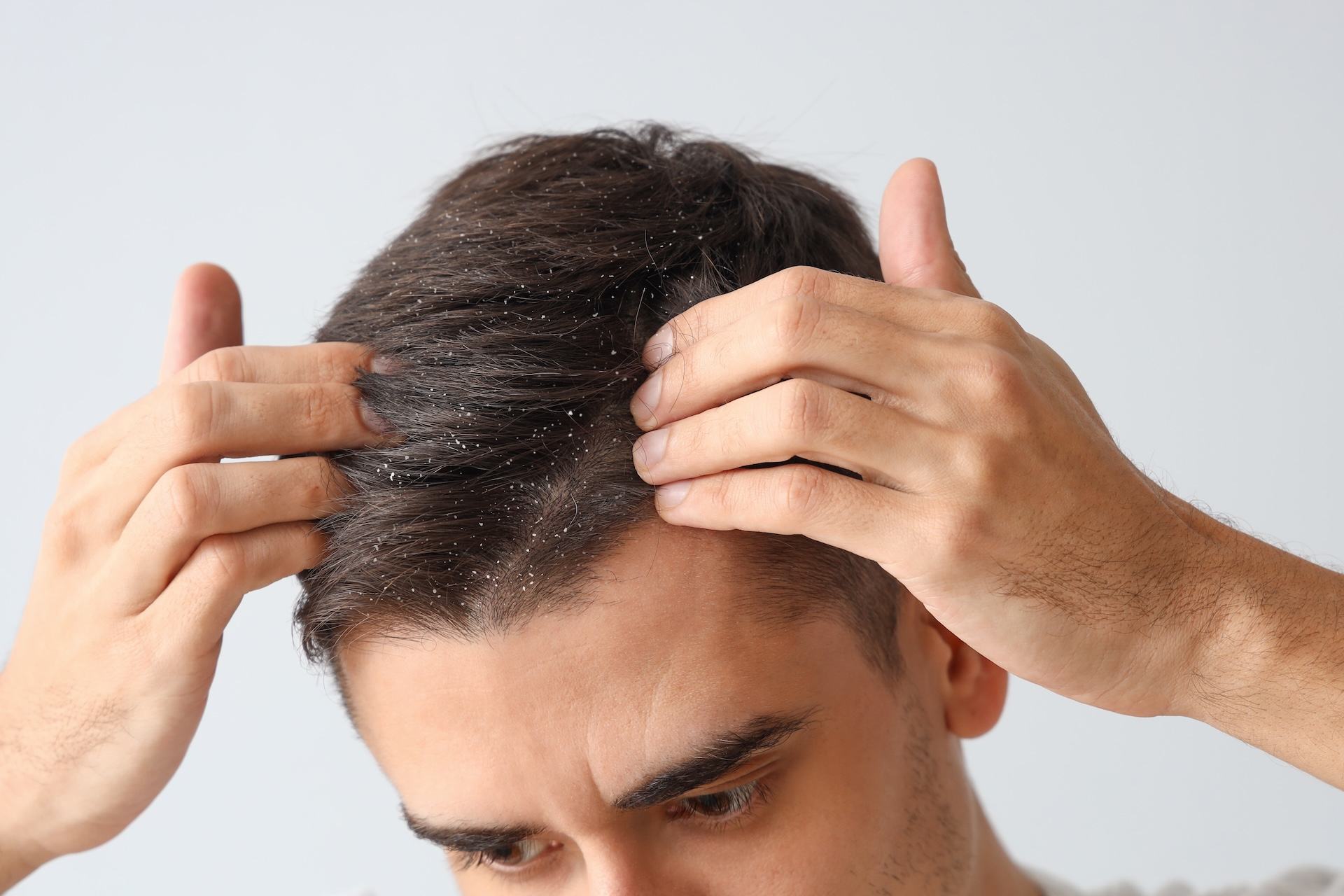 Is my dandruff causing me to lose my hair? 1 Is my dandruff causing me to lose my hair?